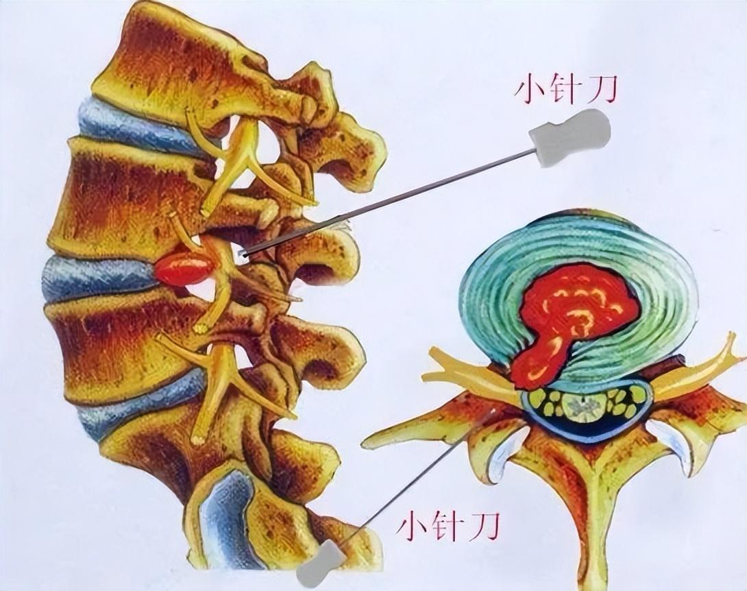 小針刀療法