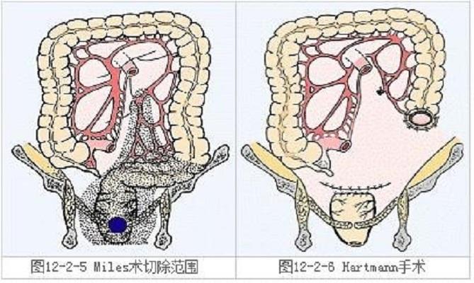 Miles手術(shù)