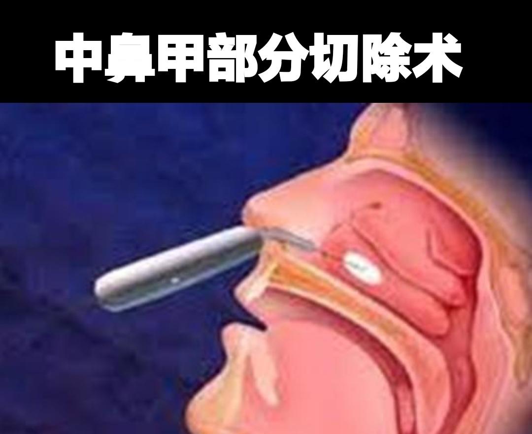 中鼻甲部分切除术