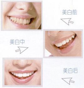 牙齿增白