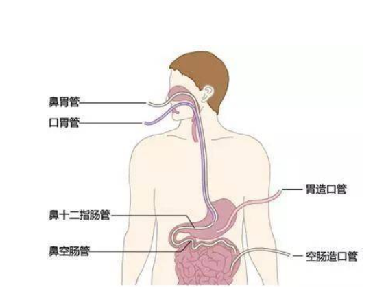 鼻空腸管