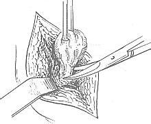 乳腺良性腫瘤切除術