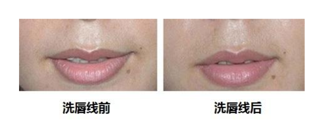 洗唇線