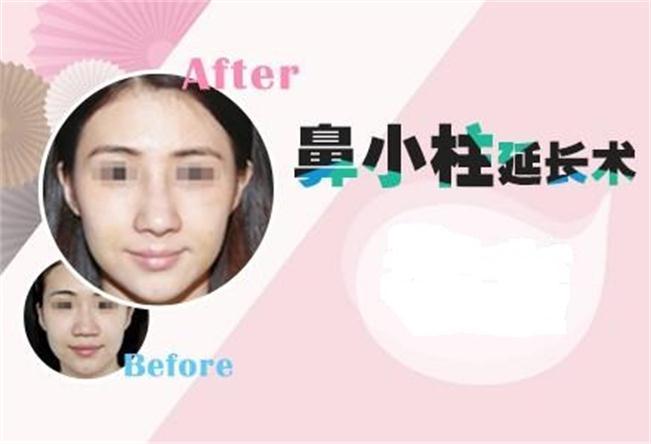 鼻小柱延長術(shù)