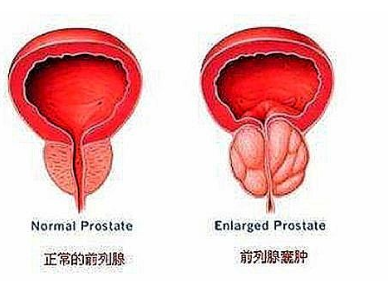前列腺囊腫